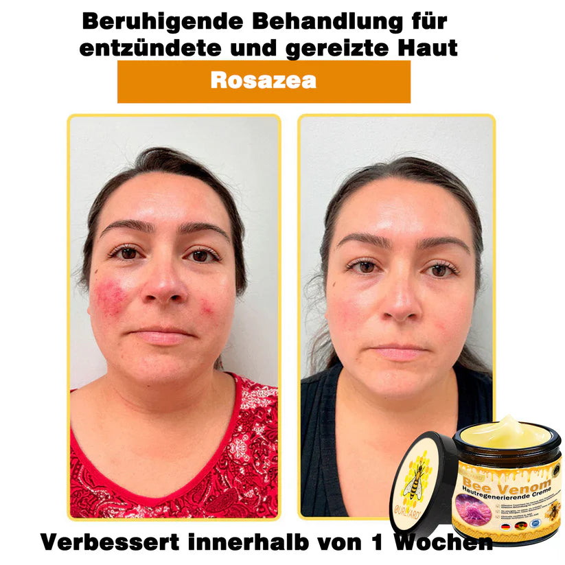 🔥Ourlyard® Bee Venom Pro Comprehensive Cream — 🔥Limited Time 80% OFF🔥