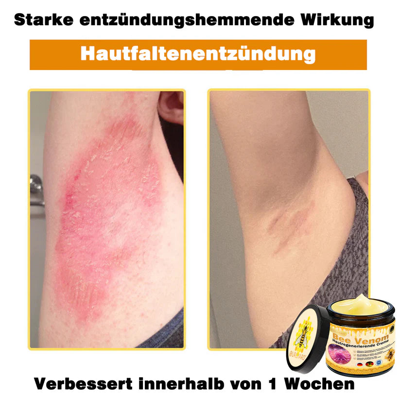 🔥Ourlyard® Bee Venom Pro Comprehensive Cream — 🔥Limited Time 80% OFF🔥