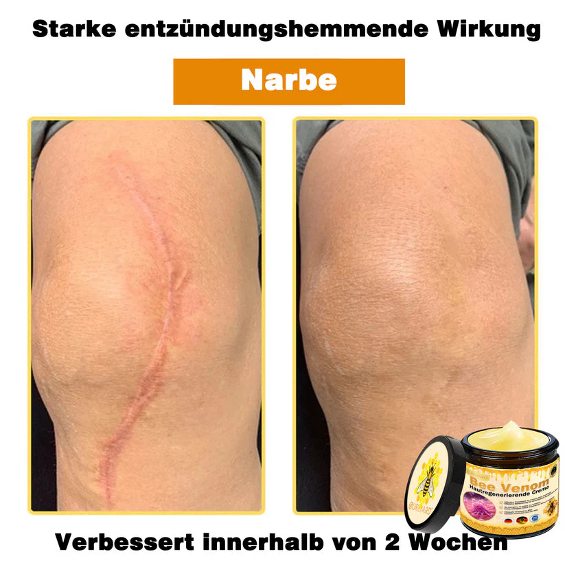 🔥Ourlyard® Bee Venom Pro Comprehensive Cream — 🔥Limited Time 80% OFF🔥